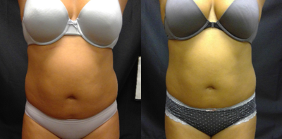 35-44 year old woman treated with BodyFX - Patient after 1 treatment.