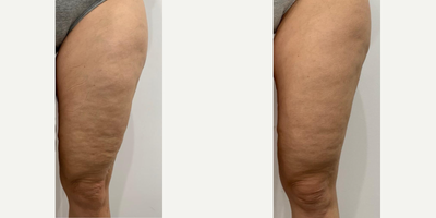 Woman treated with Emtone - Woman treated with Emtone