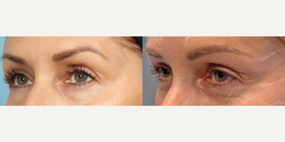 Subnovii - Before and 2 months After Subnovii TreatmentCourtesy of FreshSkin Medical Spa & Wellness Center