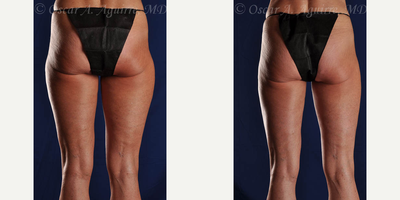 55 year old woman treated with Smart Lipo of bilateral inner and outer thighs - Smart Lipo
