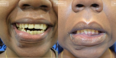 Woman treated with Scar Removal - Scar Revision