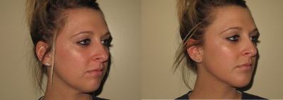 25-34 year old woman treated with Injectable Fillers / bellafill - Patient concerned about lines around mouth. Injected Bellafill in chin and Jaw law.