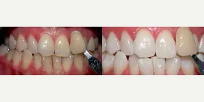 Woman treated with Teeth Whitening - Woman treated with Teeth Whitening