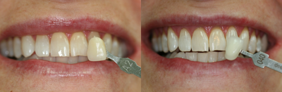 35-44 year old woman treated with BriteSmile - Whitening represents the most commonly asked for cosmetic procedure. There are several methods to use and of course depends on your particular situation. We offer 20 minute touchup whitening following a cleaning, pre-fab whitening trays, at-home whitening trays, and 1 hour power whitening procedures.
