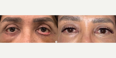 Woman treated with Eyelid Retraction Repair - This post is 50th days post-op result of lower eyelid retraction/ectropion correction caused by previous eyelid/midface surgeries.