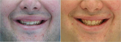 Lip Surgery, Lip Reduction - 
	Before and After upper lip surgery to remove excess red lip. This allows more upper teeth show and a more symmetric smile.

