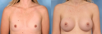 Breast Augmentation - 
	Patient Age: 33 Height: 5'3 Weight Before: 106 lbs Implant Size Left: 300 cc Implant Size Right: 300 cc Chest Measure Before: 32 inches Chest Measure After: 32 inches Cup Size Before: A Cup Size After: C
