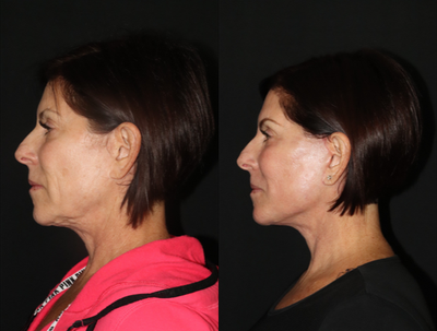45-54 year old woman treated with Facelift, Revision Neck Lift, CO2 Laser, PRP - Proceduresperformed included:1. Very conservative neck liposculpting and excision of old scar tissue from under the chin to smooth out and repair the irregularities that occurred after her previous procedure by another surgeon2. Advanced Multilayer SMAS Facelift technique to lift her cheeks, tighten her jawline, remove her old scars and excess skin in her face/neck3. CO2 laser skin resurfacing and platelet rich plasma ( PRP ) to tighten and improve her skin quality