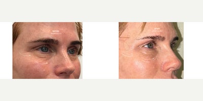 65-74 year old woman treated with CO2 Laser, Secret RF, Microneedling - Treatment: RF Microneedling + CO Laser ResurfacingThese before-and-after photos highlight the remarkable improvement that can be achieved with a customized combination of RF Microneedling and CO laser resurfacing. Notice the smoother skin texture, softening of the lines above and below the eyes, improvement in smile lines, refinement of the chin, reduced cheek creasing, and a more defined jawline. By stimulating collagen production while resurfacing the skin, this treatment improves overall skin quality, firmness, and texture for a naturally refreshed appearance. My patient is absolutely thrilled with her results, and the improvement will continue as collagen remodels over the coming months.