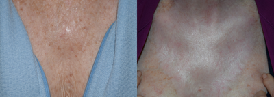 65-74 year old woman treated with Renuvion - Chest treated with Renuvion