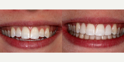 Lumineers - 23 year-old female complained of an uneven look to her teeth. After an aesthetic evaluation it was decided to treat only the two lateral incisors. 2 Lumineers were placed on the 2 short Laterals. Total treatment time 2 weeks.