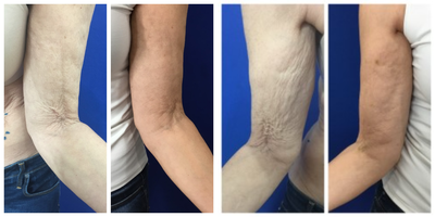 55-64 year old woman treated with Profound RF - Profound has 100% response rate and 37% tightening of skin. This patient's arms responded beautifully and this is 6 weeks post procedure.