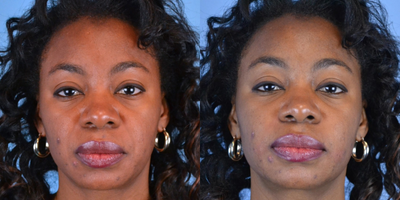 45-54 year old woman treated with ArteFill - 46 year old female received Artefill to nasolabial folds
