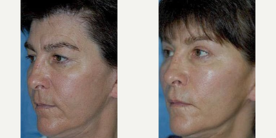 Woman treated with Thread Lift - Woman treated with Cheek Lift and Thread Lift