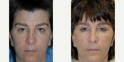 Woman treated with Thread Lift - Woman treated with Cheek Lift and Thread Lift