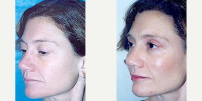 Woman treated with Thread Lift - Woman treated with Cheek Lift and Thread Lift