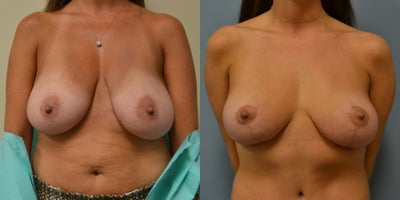 38 year old woman treated with Breast Reduction - 38 year old woman treated with Breast Reduction