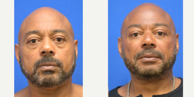 55-64 year old man treated with Eyelid Surgery, Daxxify, Cheek Fillers, RHA Collection Fillers - Lower Blepharoplasty Filler to the cheeks and NLFDaxxify to the upper face