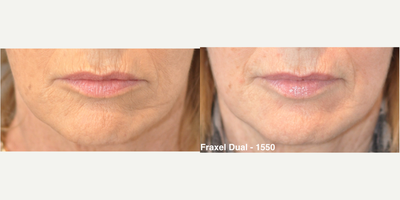 55-64 year old woman treated with Fraxel Laser, Fraxel Repair - Fraxel Dual Laser Treatment