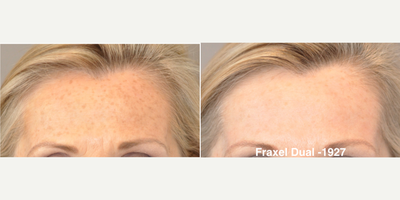55-64 year old woman treated with Fraxel Laser, Fraxel Repair - Fraxel Dual Laser Treatment