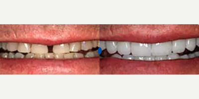 45-54 year old man treated with Smile Makeover - 52 year old man wanted to close the space between his two front teeth. He had braces as a young adult to close the gap, but it reappeared about 10 years ago. He also complained of worn and short teeth. Treatment included veneers on both his upper and lower teeth. We were able to close the gap and to give him a more youthful look by lengthening his teeth.