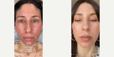 Woman treated with Bellafill, Subcision, CO2 Laser, PlasmaPen - Woman treated with Bellafill, Subcision, CO2 Laser, PlasmaPen