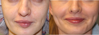 35-44 year old woman treated with Rhinoplasty - Open rhinoplasty, dorsal hump reduction, tip refinement.