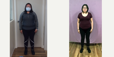 25-34 year old woman treated with Endoscopic Sleeve Gastroplasty - She lost 51 LBS in 13 months after her Endoscopic Sleeve Gastroplasty.