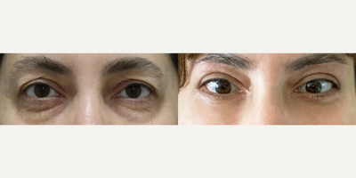 45-54 year old woman treated with Eyelid Surgery, Canthoplasty - Lower Blepharoplasty + Canthopexy