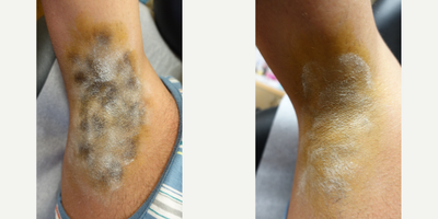 39 year old man treated with miraDry - miraDry is a permanent solution to reduce underarm sweat. This gentleman received his treatment, the black spots shown are areas of sweat production found doing a starch test. Two weeks after the treatment was performed, the starch test is performed again to show any areas that may still be producing sweat.