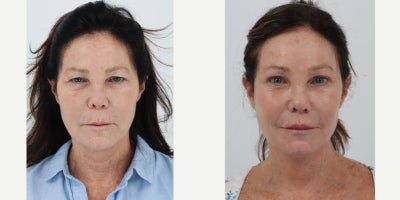 55-64 year old woman treated with Facelift, Neck Lift, Brow Lift, Eyelid Surgery, Facial Fat Transfer, Lip Lift, CO2 Laser - 63 years old 7 months after a Deep Plane Facelift, Neck lift, Brow lift, Lip lift, Upper and lower blepharoplasty, fat transfer and co2 laser skin resurfacing with Dr. Dilip D. Madnani, MD FACS