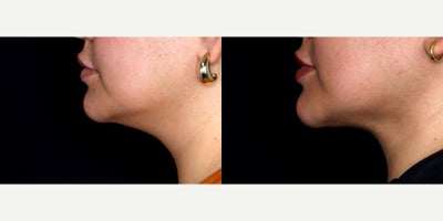 28 year old woman treated with Liposuction, chin Fat Transfer, PrecisionTx - 28 year old female treated with liposuction to the submental neck (double chin) and fat transfer to chin. Photos depict before and 3 weeks after surgery