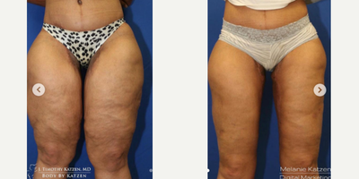 25-34 year old woman treated with Thigh Lift - This 34 year old female patient weighed 240 pounds. The patient then underwent RNY and lost 130 pounds. After the weight loss, they did not like the excess skin and fat of their thighs. So, Dr. Katzen performed a thigh reduction. Please note the significant reduction in the size of the patients thighs! Now, their thighs are proportional to the rest of the body and better support the patient!