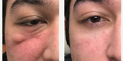 25-34 year old man treated with Scar Removal - Multiple modality treatment of facial scarring leads to best results. This was a combination of 5FU, BBL, Erbium 2940nm laser, and surgery.