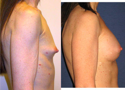 Tuberous Breast Augmentation, Round Gel 250cc, Dual Plane - Tuberous Breast Augmentation, Round Gel 250cc, Dual Plane