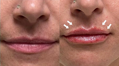 Woman treated with Lip Fillers - Woman treated with Lip Fillers