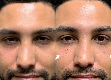 Man treated with Dermal Fillers, Botox - Man treated with Dermal Fillers, Botox