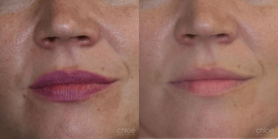 Dilated Pores Treatment using Chemical Peel - Skin pores allow the skin to breathe and to evacuate impurities. They can sometimes become clogged and dilated, giving the skin an irregular appearance. This condition can be effectively treated with chemical peels.