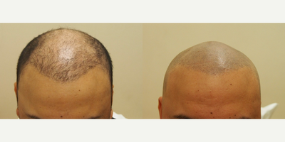 45-54 year old man treated with Scalp Micropigmentation - 45-54 year old man treated with Scalp Micropigmentation