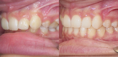 17 or under year old woman treated with Clear Braces - Teenage girl with a very deep bite, receded chin, and buck teeth.
One and a half years of Invisalign treatment.  Used rubber bands to help with jaw alignment.