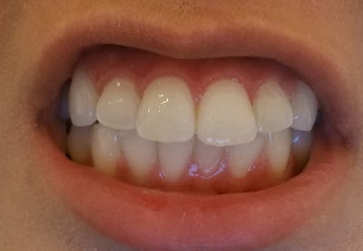 teeth flared angled fix protruded straight very reshaped answers