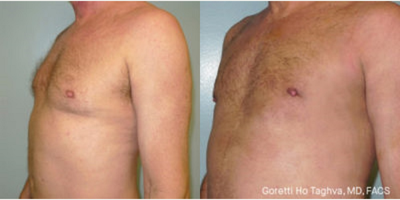 Man treated with Gynecomastia Surgery - Man treated with Gynecomastia Surgery