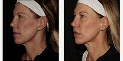 Woman treated with Emface - Emface