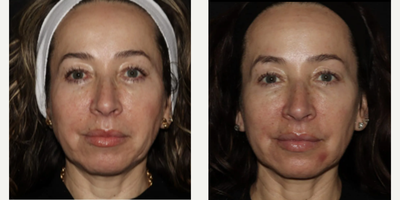 Woman treated with Emface - Emface