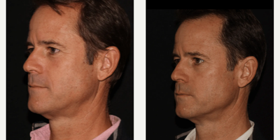 Man treated with Emface - Emface