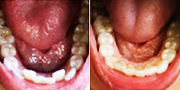 Straighten your teeth without braces - Photo provided courtesy of SmileDirectClub.