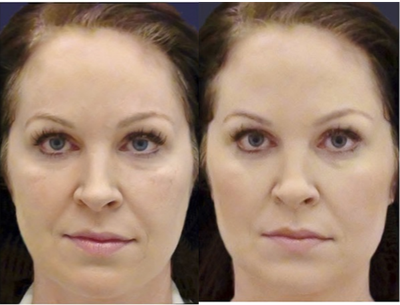 35-44 year old woman treated with Cheek Augmentation - Cheek augmentation with Juvederm Voluma