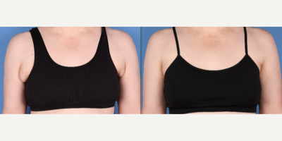45 year old woman treated with Power-Assisted Liposuction (PAL), Liposuction - Liposuction to remove excess fat of pre-axilla