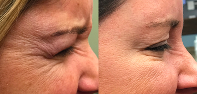 35-44 year old woman treated with Botox for the periocular area - This woman is doing very well with some botox around her eyes. It really makes a nice difference in this area. If you are able to combo this with something like thermismooth it can put a cherry on top!