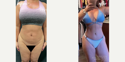 18-24 year old woman treated with Tummy Tuck, Liposuction and Skin Tightening - 18-24 year old woman treated with Tummy Tuck, Back Liposuction and J-Pasma
